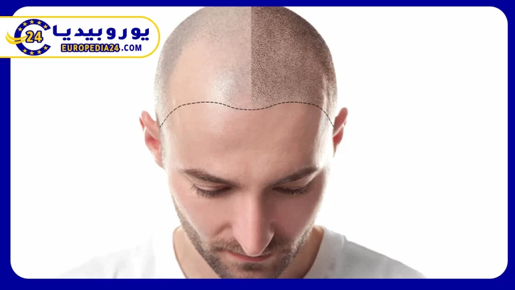 الأعراض-الجانبية-لزراعة-الشعر-في-تركيا