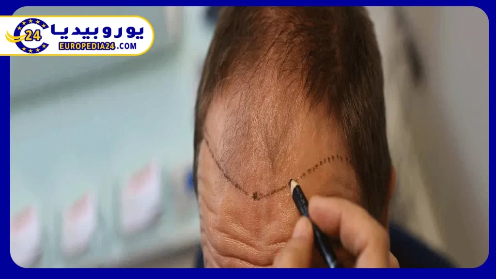 ما هي تكلفة زراعة الشعر في تركيا؟ 2 أفضل التقنيات المستخدمة في زراعة الشعر في تركيا