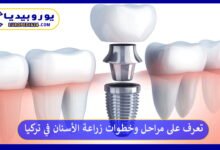 زراعة-الأسنان-في-تركيا