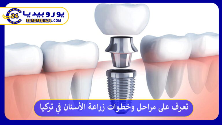 زراعة الأسنان في تركيا