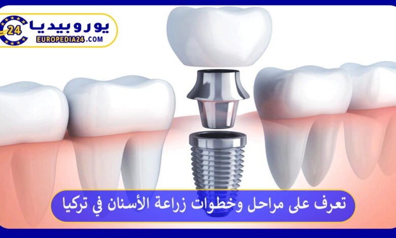 تعرف على مراحل وخطوات زراعة الأسنان في تركيا 78 زراعة-الأسنان-في-تركيا
