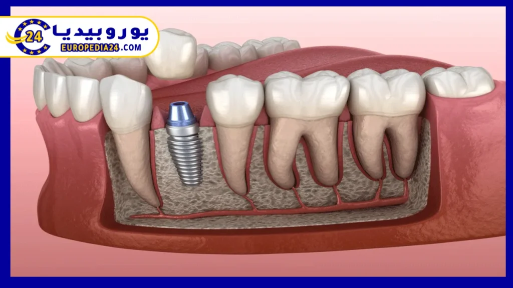 تعرف على أنواع زراعة الاسنان في المانيا وتكلفتها 2 زراعة-الأسنان