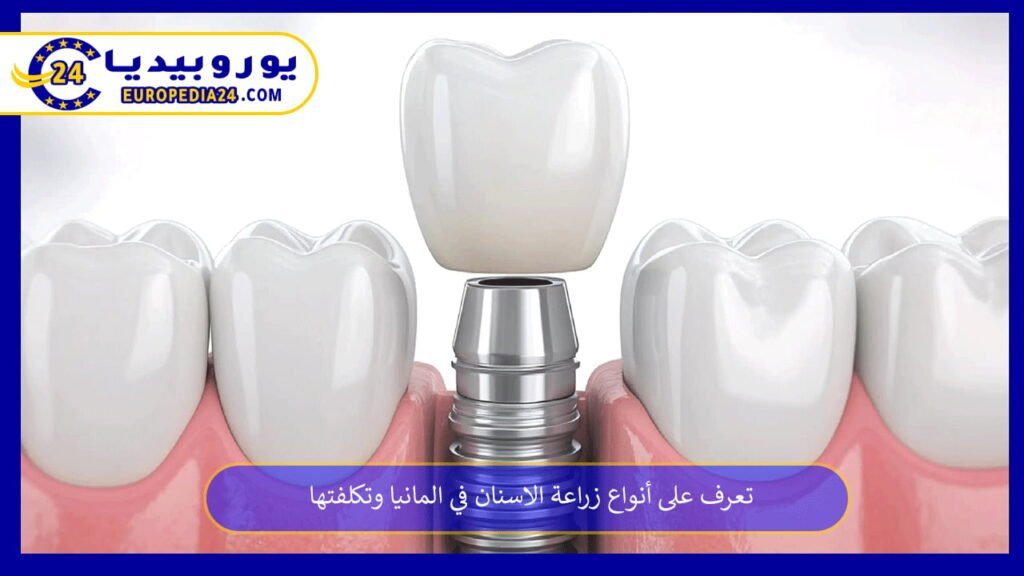 تعرف على أنواع زراعة الاسنان في المانيا وتكلفتها 1 زراعة-الاسنان-في-المانيا
